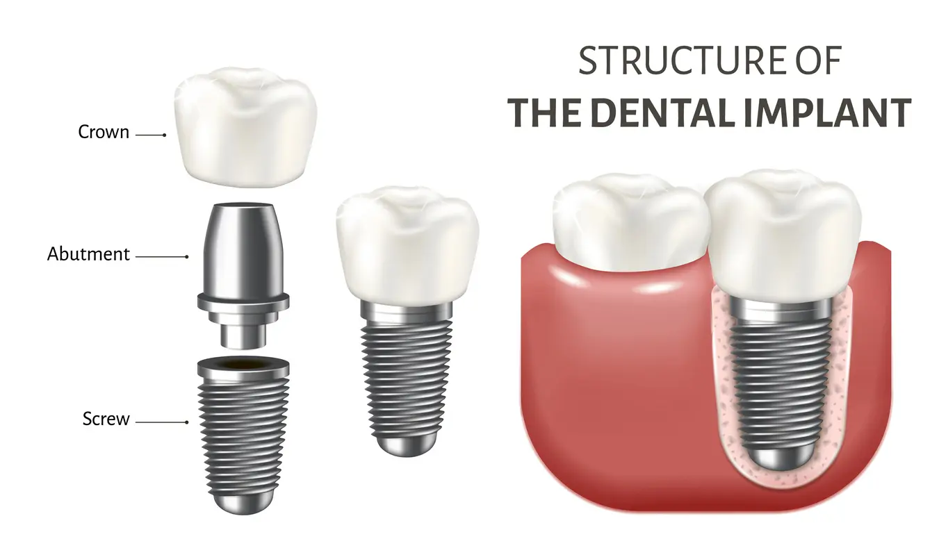 What are Dental Implants
