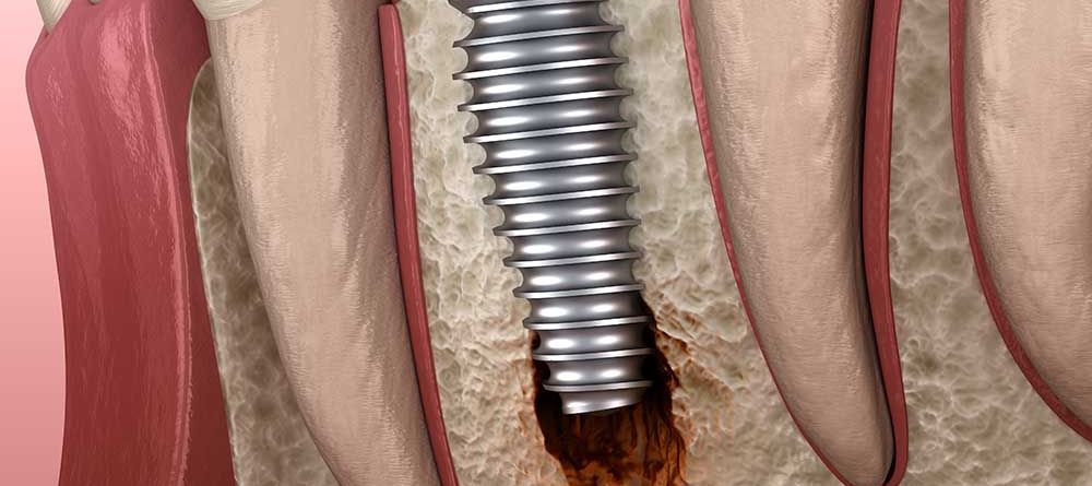 What is Peri-implantitis