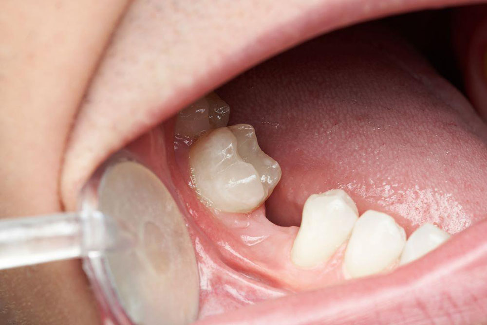 Why Replacing Missing Teeth is Important