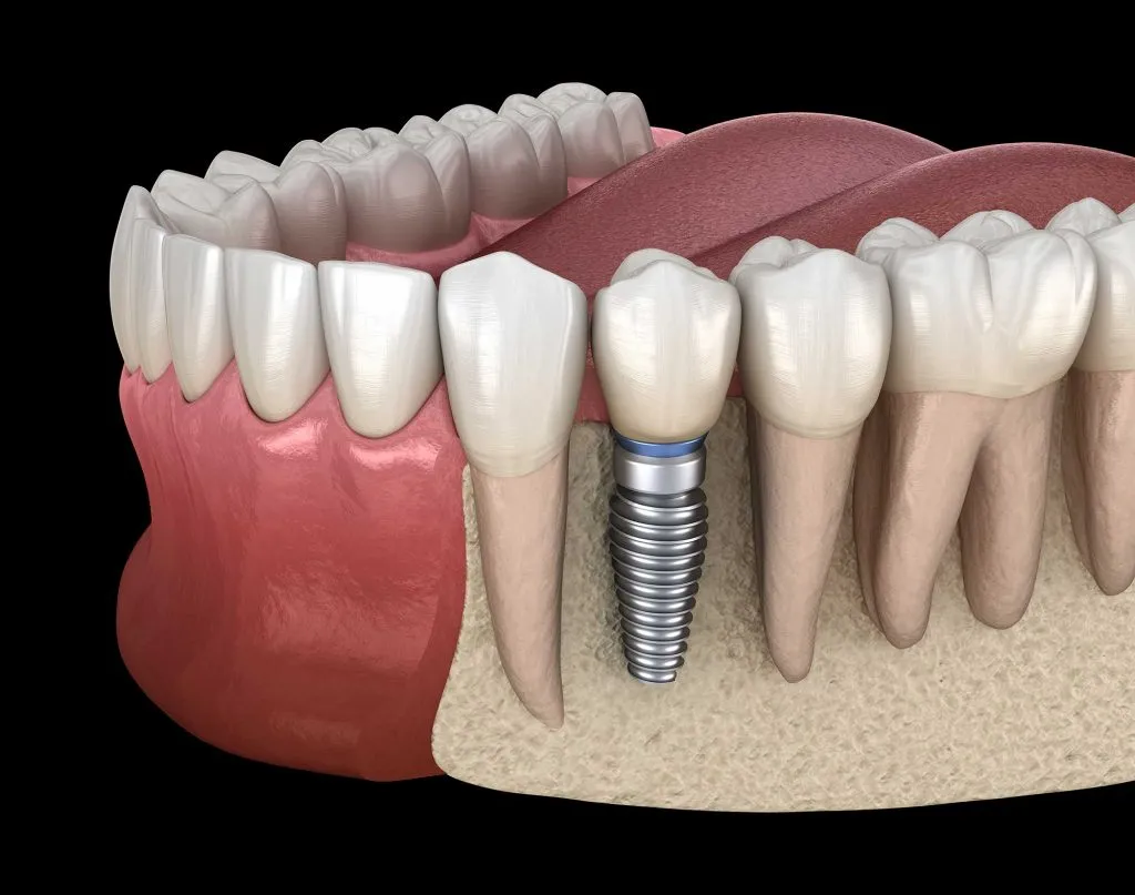 Why Is Osseointegration Needed?