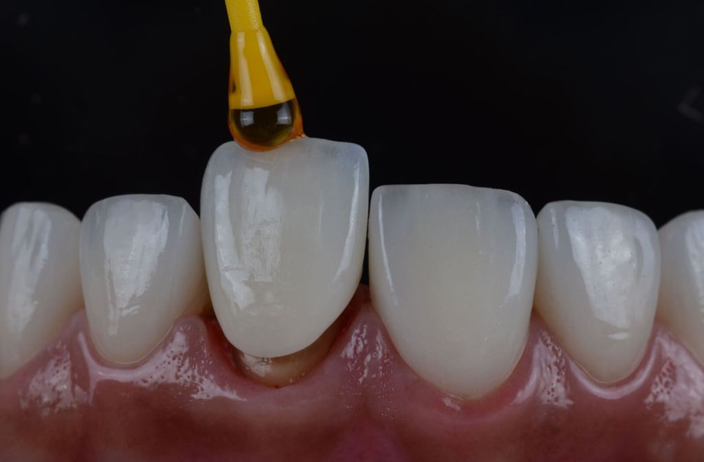 Dental Crowns To Fix Bad Teeth