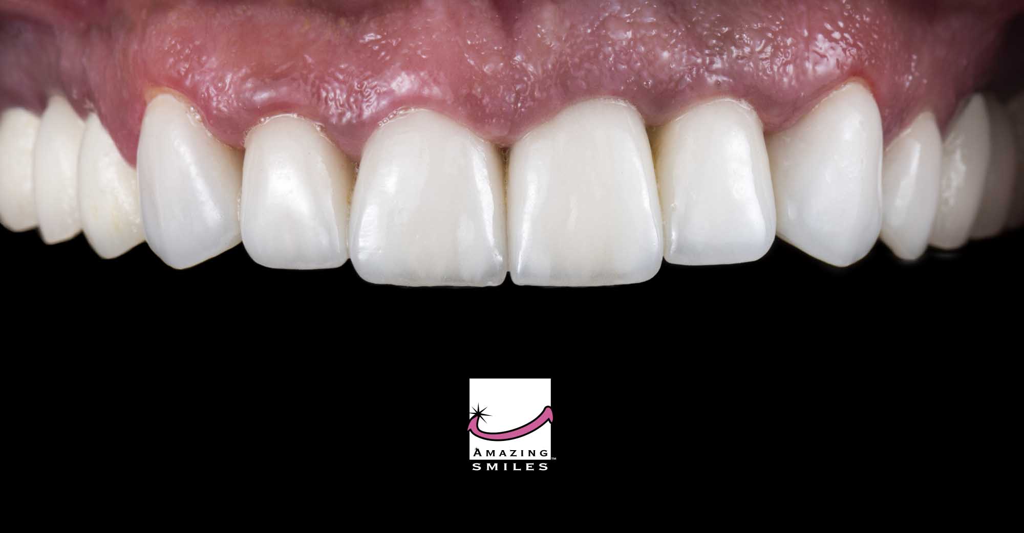 Gold Coast Dentist For Porcelain Veneers