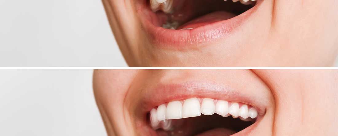 Complete Guide To Composite Veneers