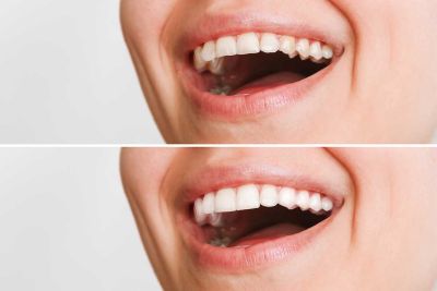 Complete Guide to Composite Veneers