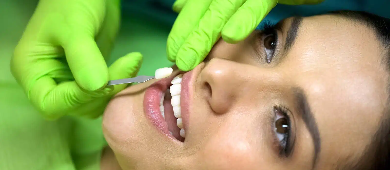 Dental Veneers Cosmetic Dentist Near Me