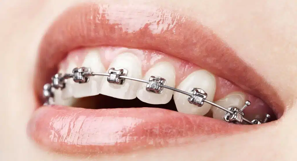 Orthodontics For Bad Teeth