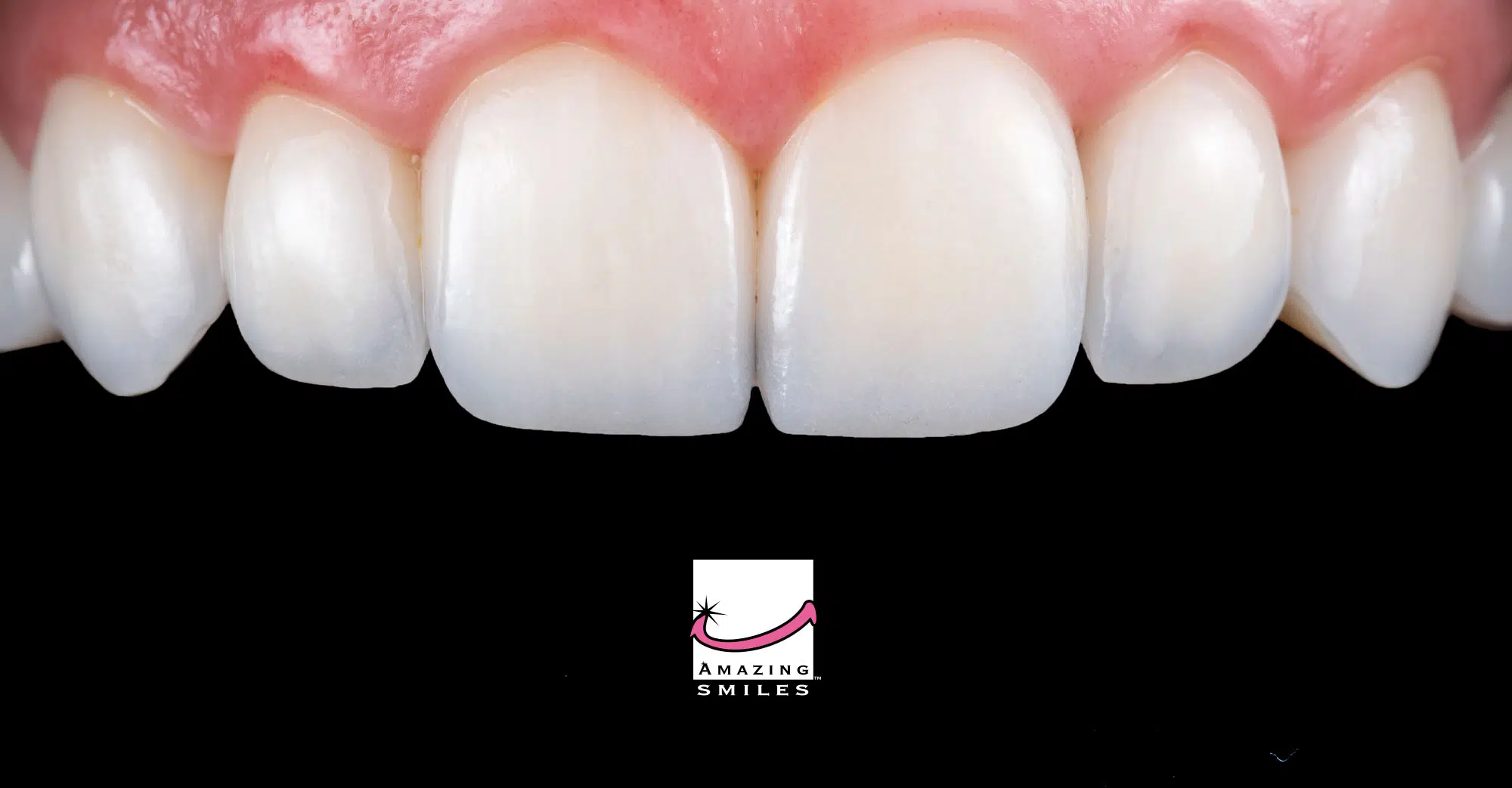 What To Expect When Getting Composite Veneers