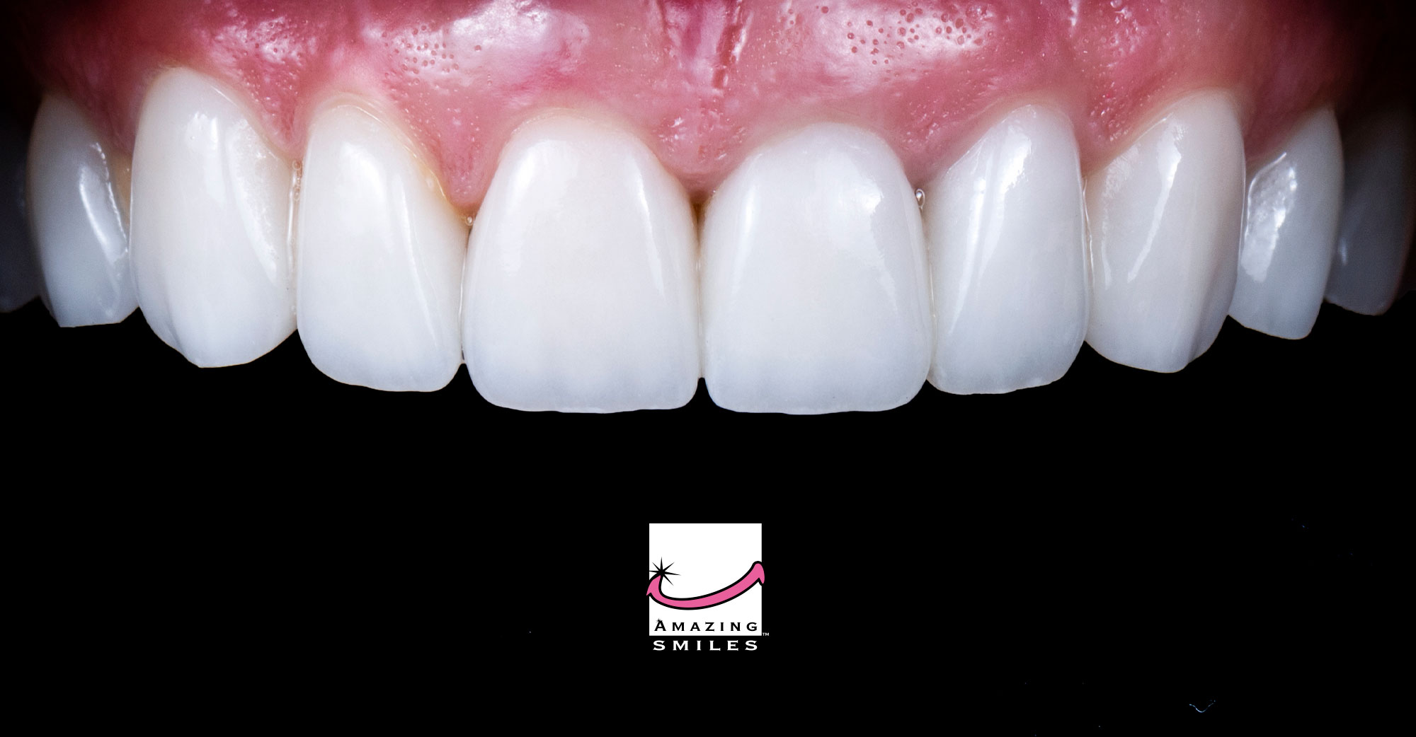 What To Expect When Getting Porcelain Veneers