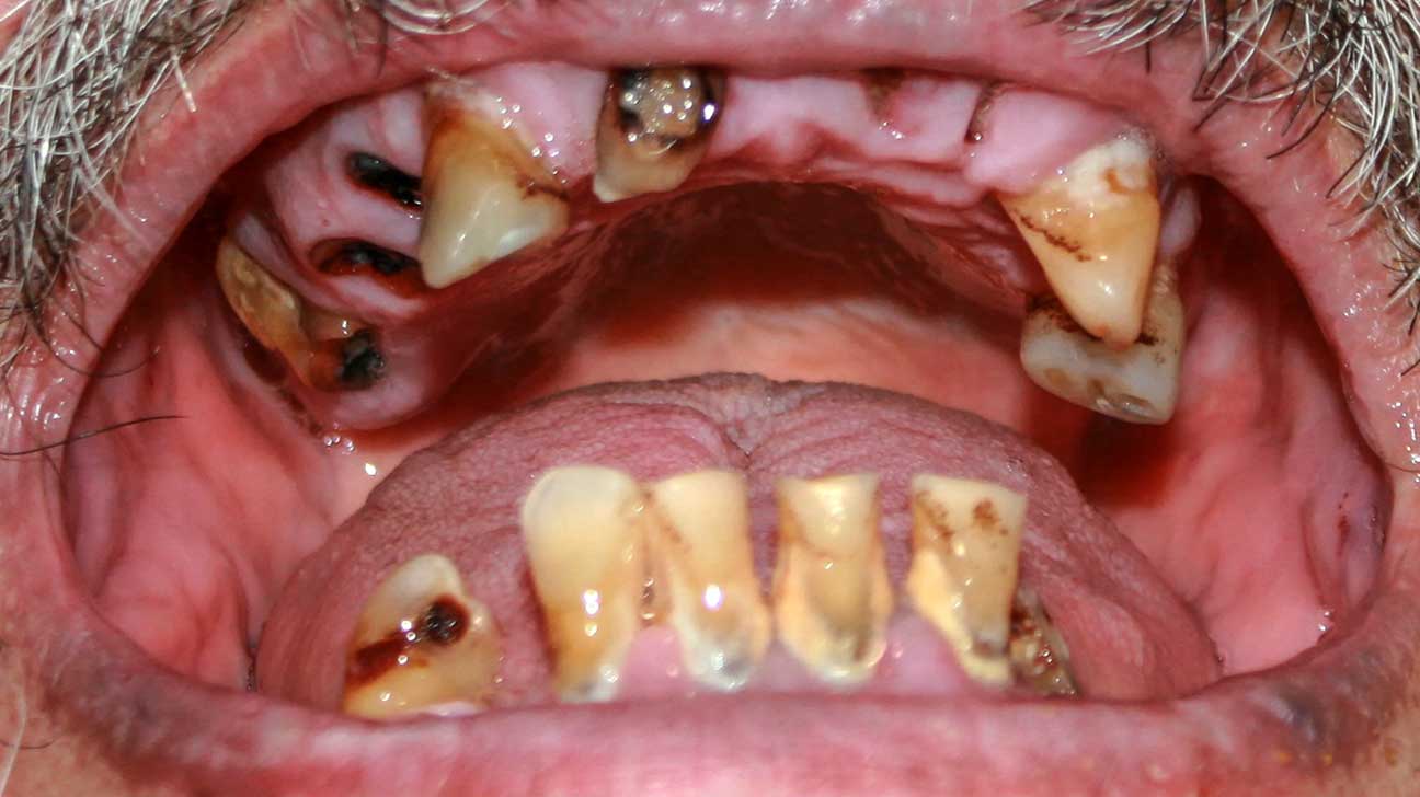 Gum And Periodontal Disease From Illicit Drugs