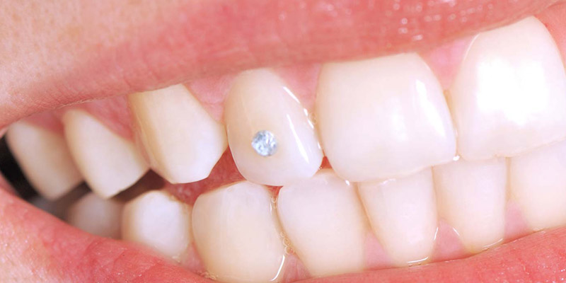 Dental Gems