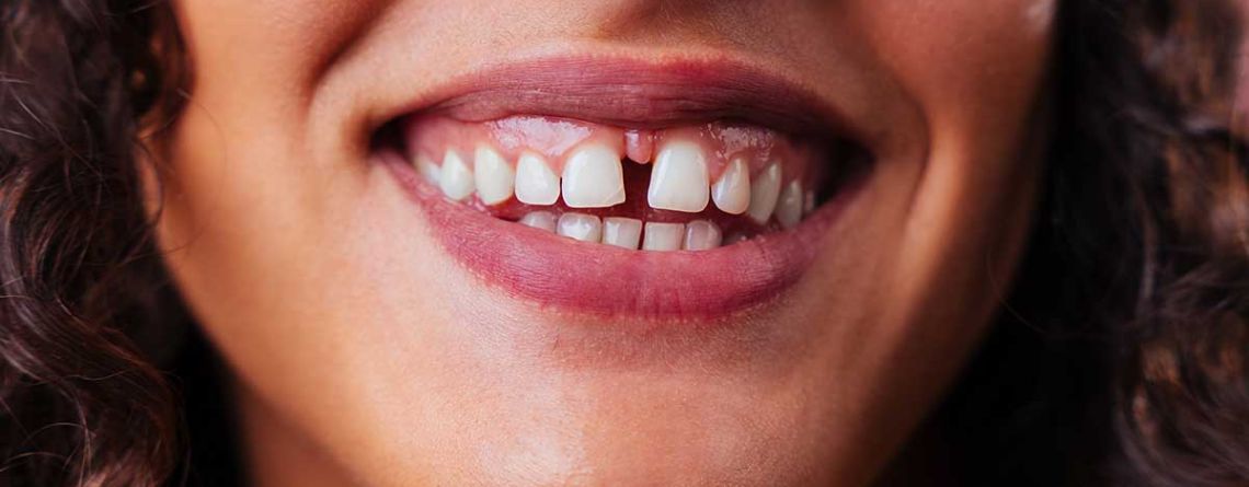 A Gap In Front Teeth - Diastema Causes and Treatment