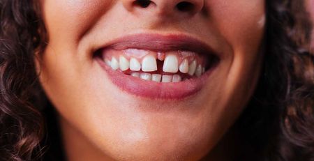 A Gap In Front Teeth - Diastema Causes and Treatment