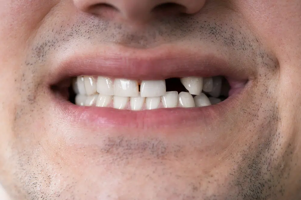 Ramifications Of Tooth Loss: Impact On Oral &Amp; Overall Health