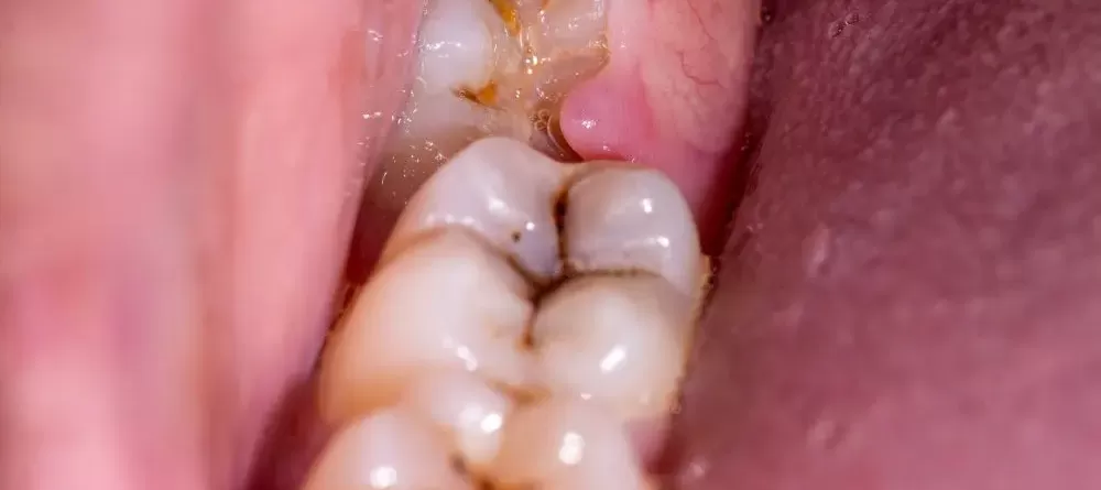 Comprehensive Guide To Wisdom Tooth Removal