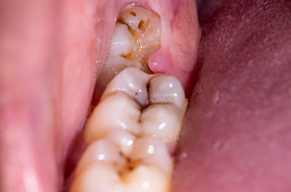 Comprehensive Guide to Wisdom Tooth Removal