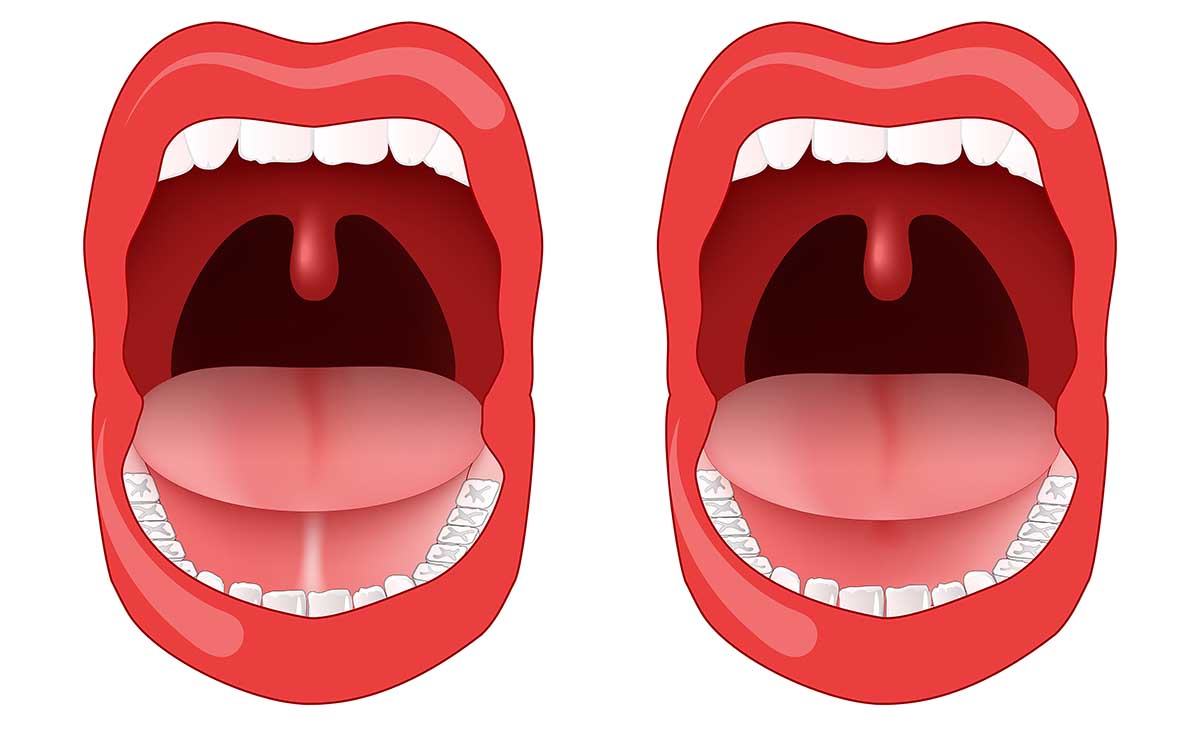 Ankyloglossia, Tongue-Tie Frenum