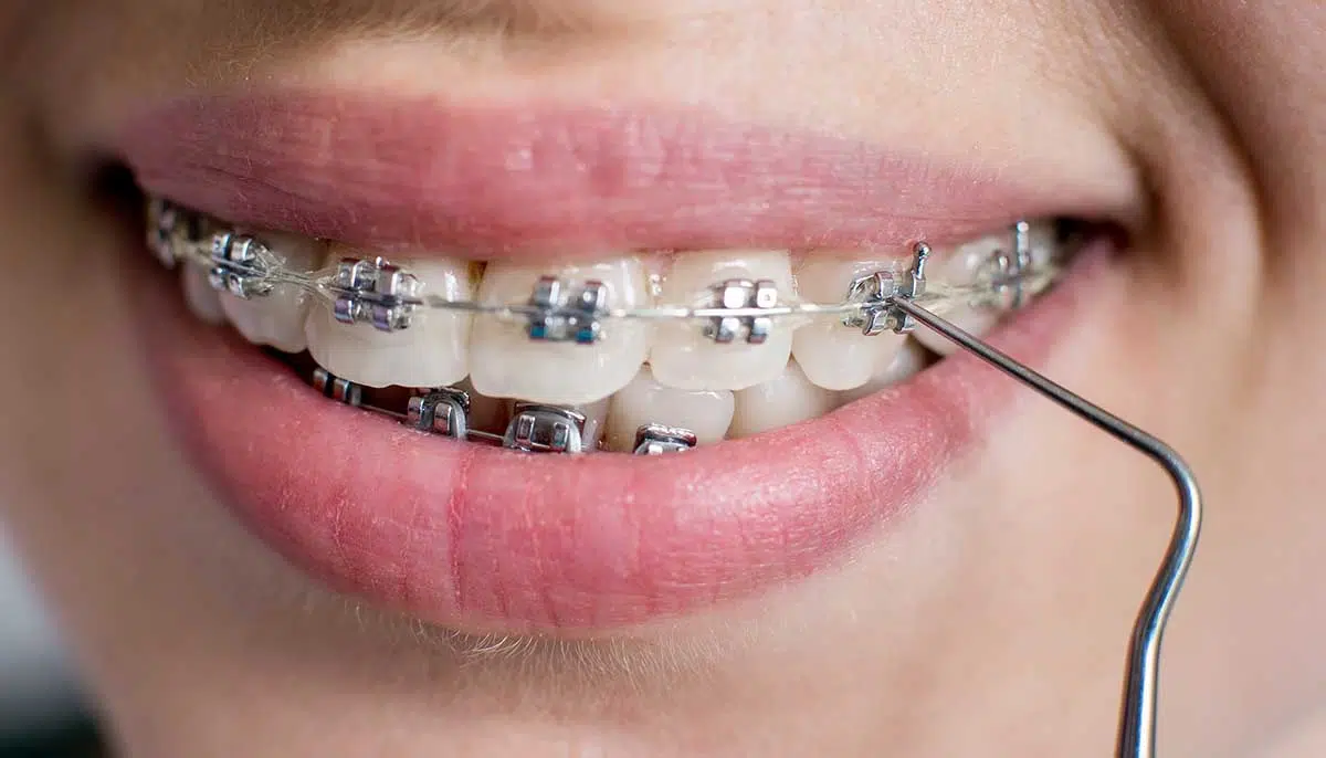 Dental Braces Gold Coast Orthodontics