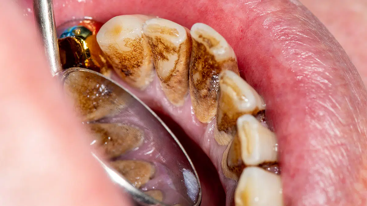 Formation Of Dental Calculus - Limestone Plaque 