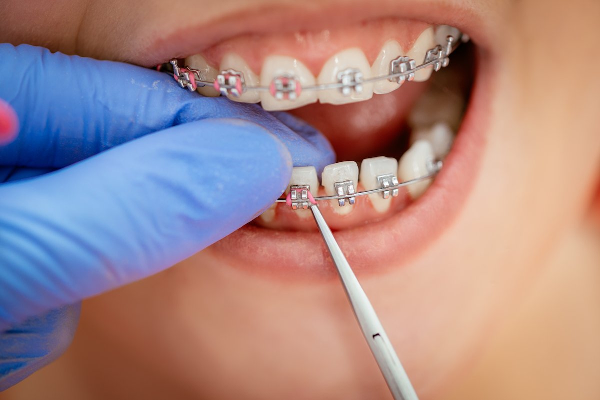 Importance Of Regular Visits To Your Cosmetic Dentist For Dental Braces During Orthodontic Treatment