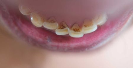 Limestone Plaque in Dentistry: Understanding Dental Calculus