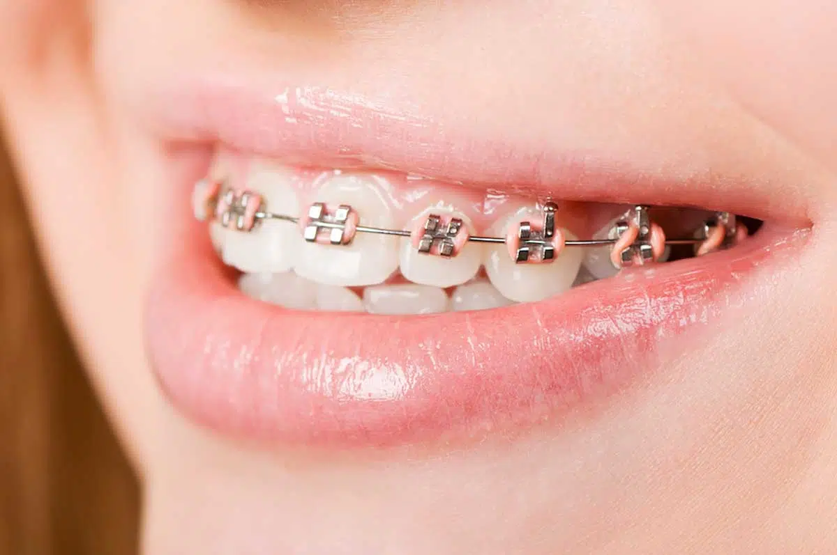 Understanding Dental Braces And Their Components