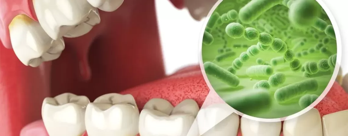 What is Oral Microbiome? - Amazing Smiles Family Dentist Gold Coast