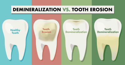 What is the Difference Between Demineralization and Tooth Erosion?