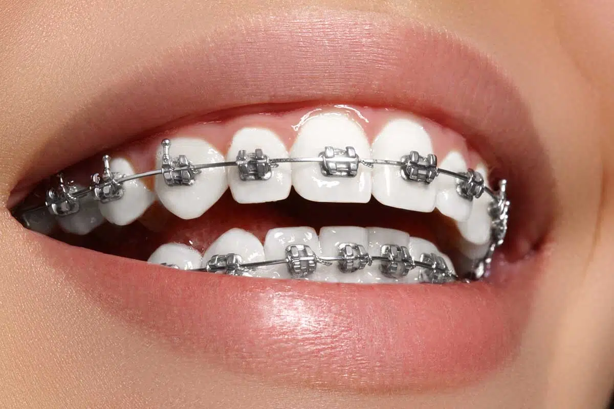 What to Do if a Bracket Detaches During Orthodontic Treatment