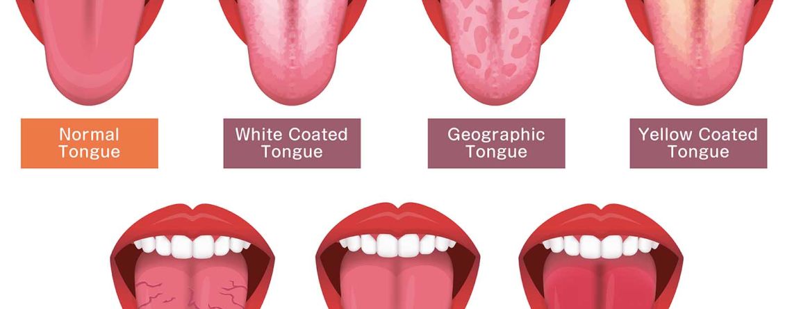 Deciphering Health Clues From Your Tongue