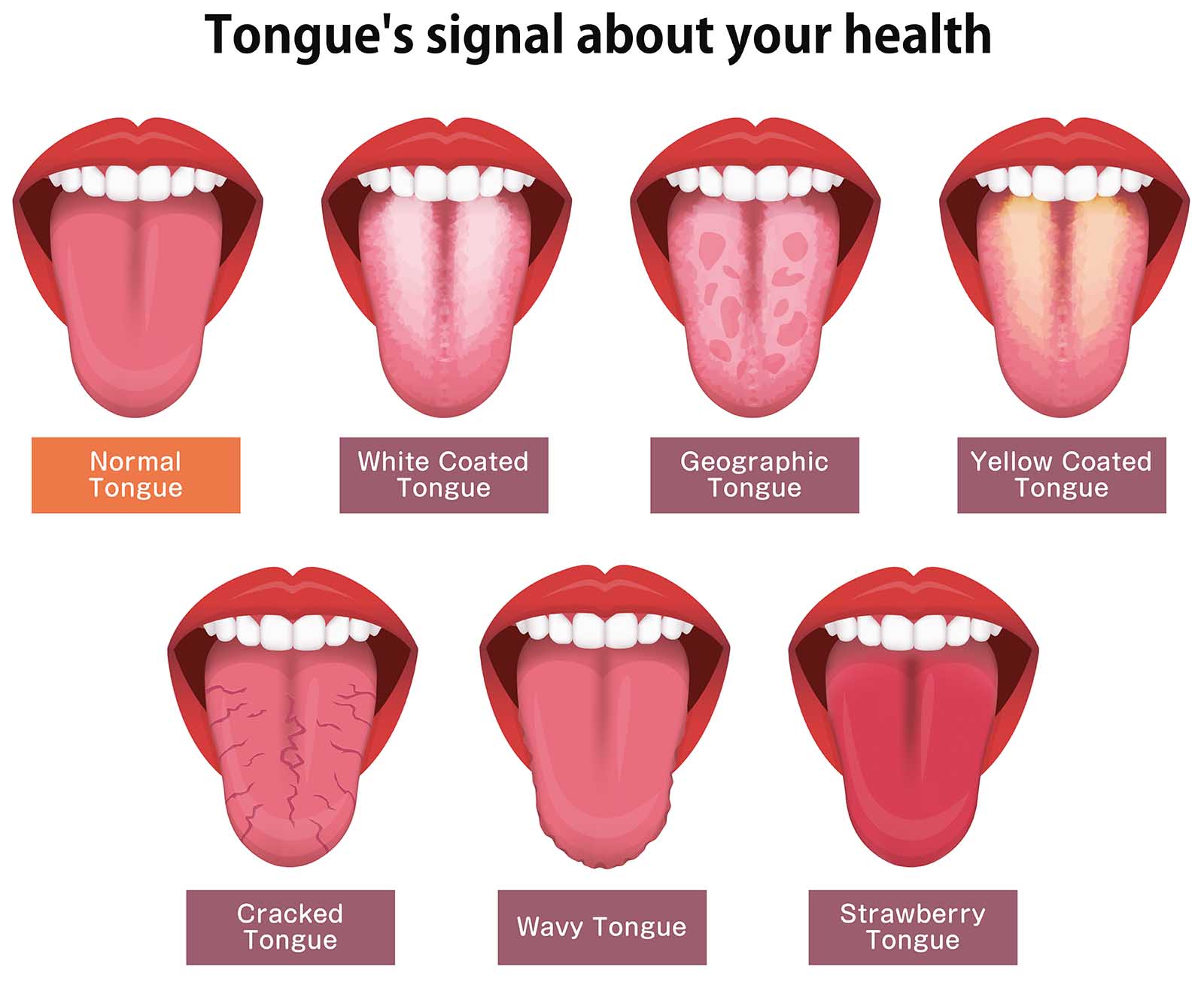 Deciphering Health Clues from Your Tongue