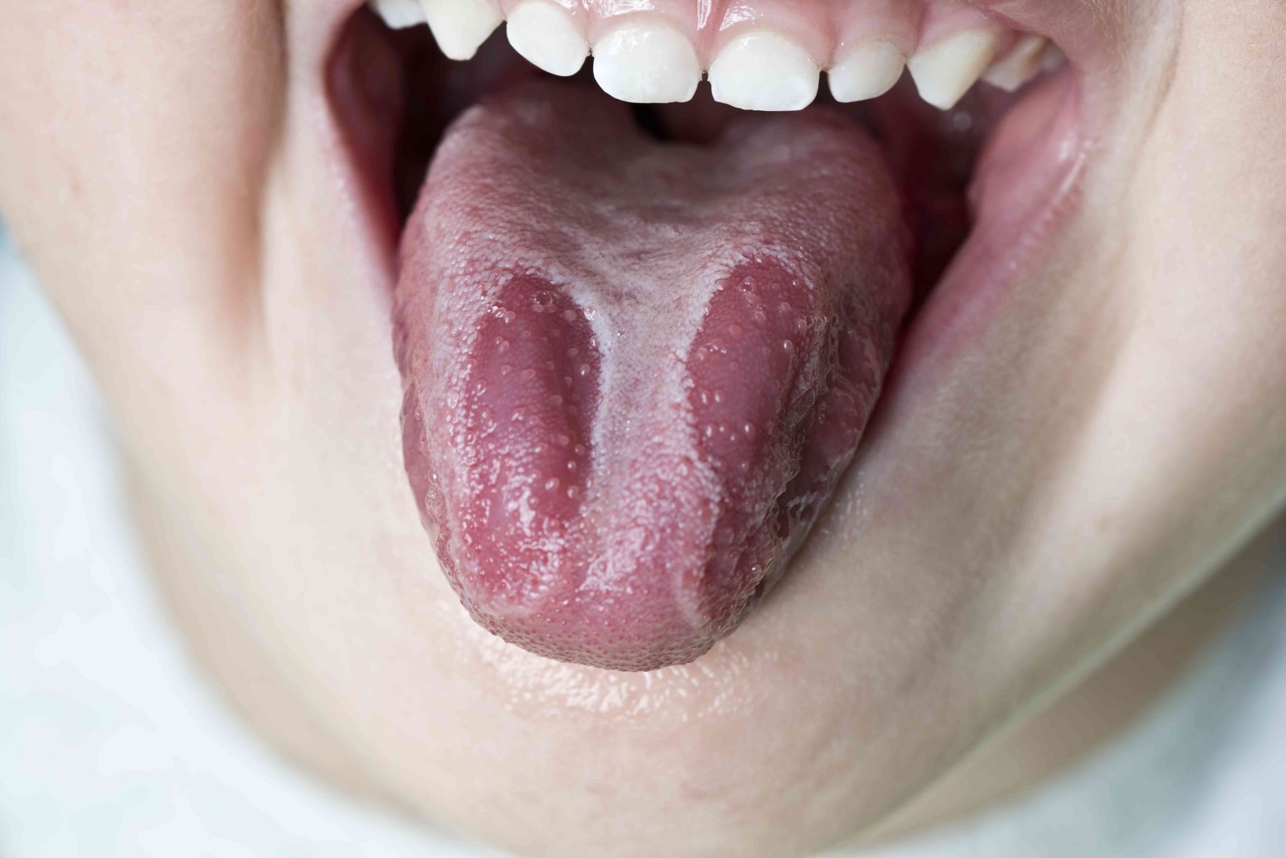 What Is Geographic Tongue? Amazing Smiles Dental Hygiene