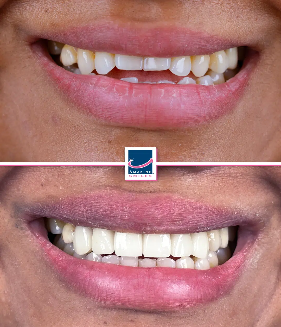 Porcelain Veneers Logan Dentist