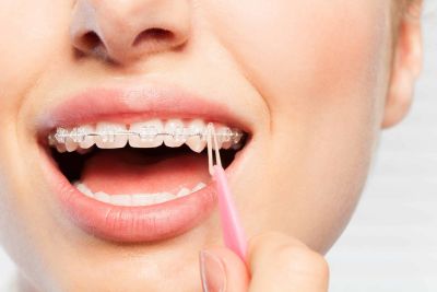 Understand The Purpose of Rubber Bands in Orthodontic Treatment