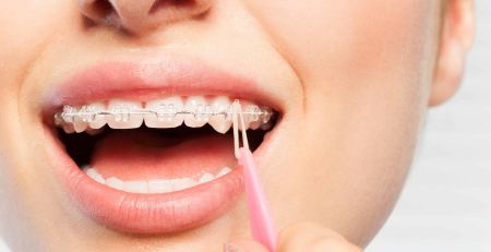 Understand The Purpose of Rubber Bands in Orthodontic Treatment