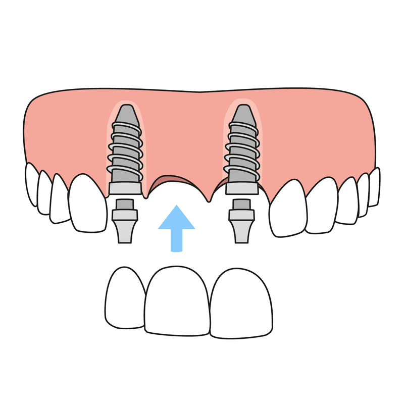 Dental Implant Bridge Gold Coast