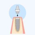 Dental Abutment Placed On Implant