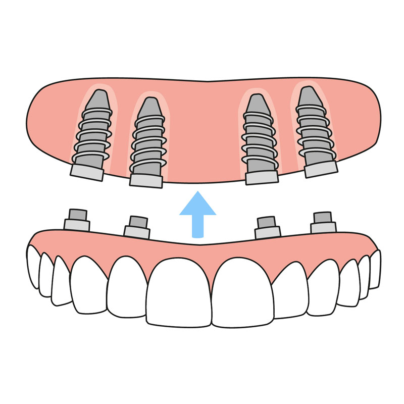 Implant Dentures Gold Coast