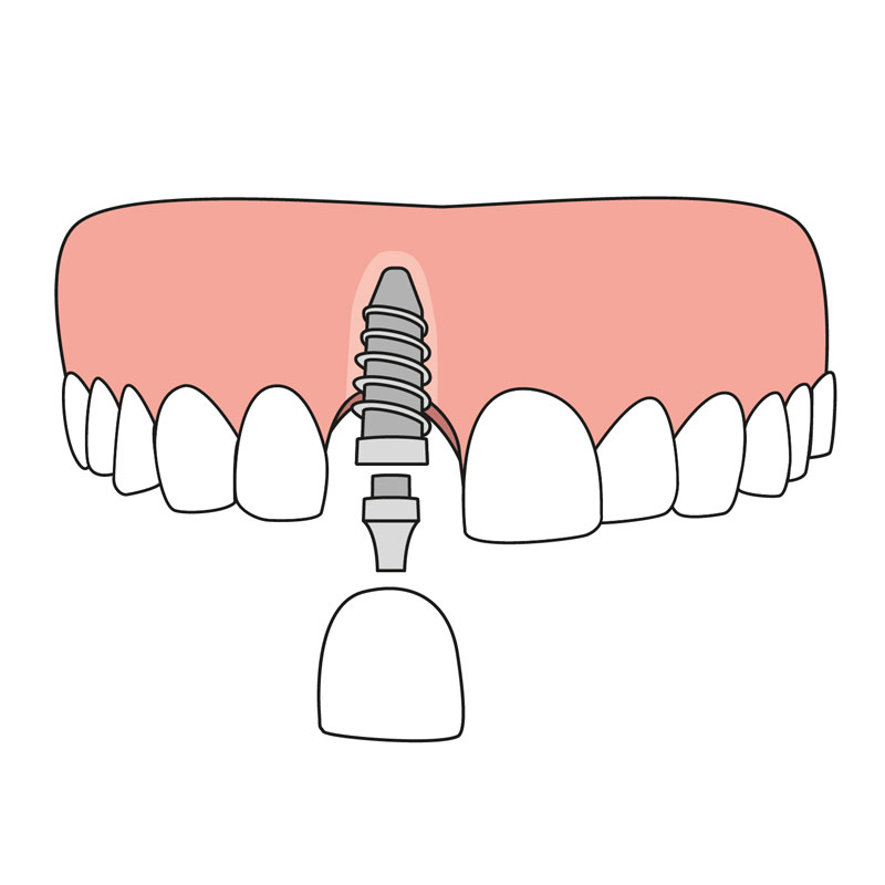 Single Tooth Implants Gold Coast