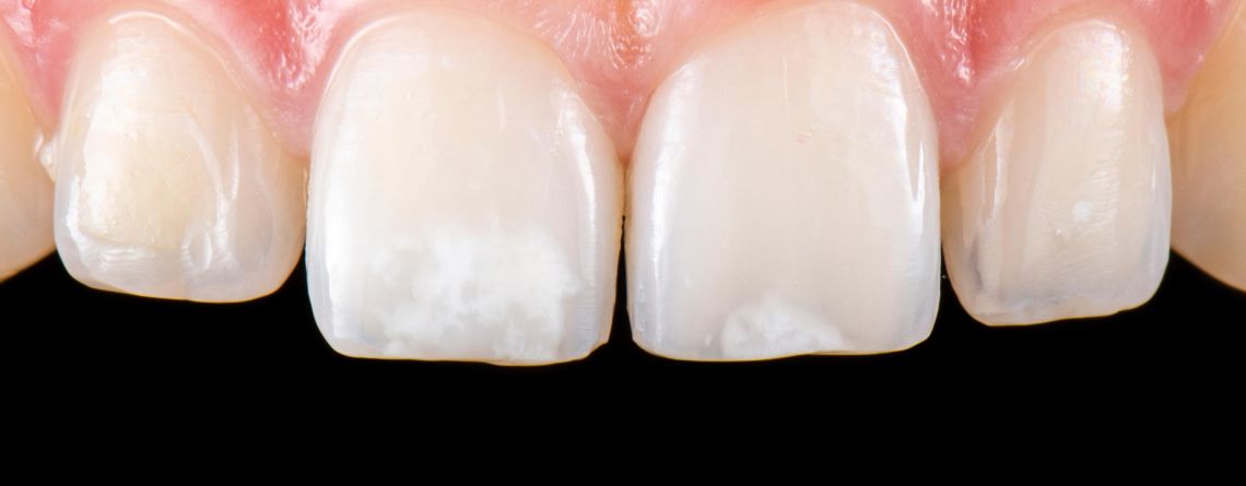 What Is Enamel Hypocalcification?