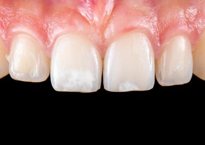 What is Enamel Hypocalcification?