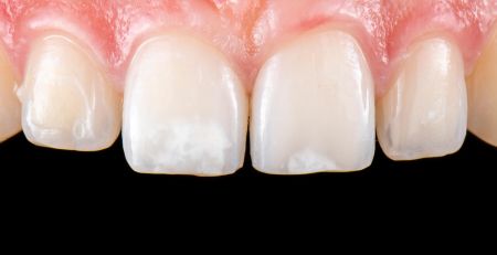 What is Enamel Hypocalcification?
