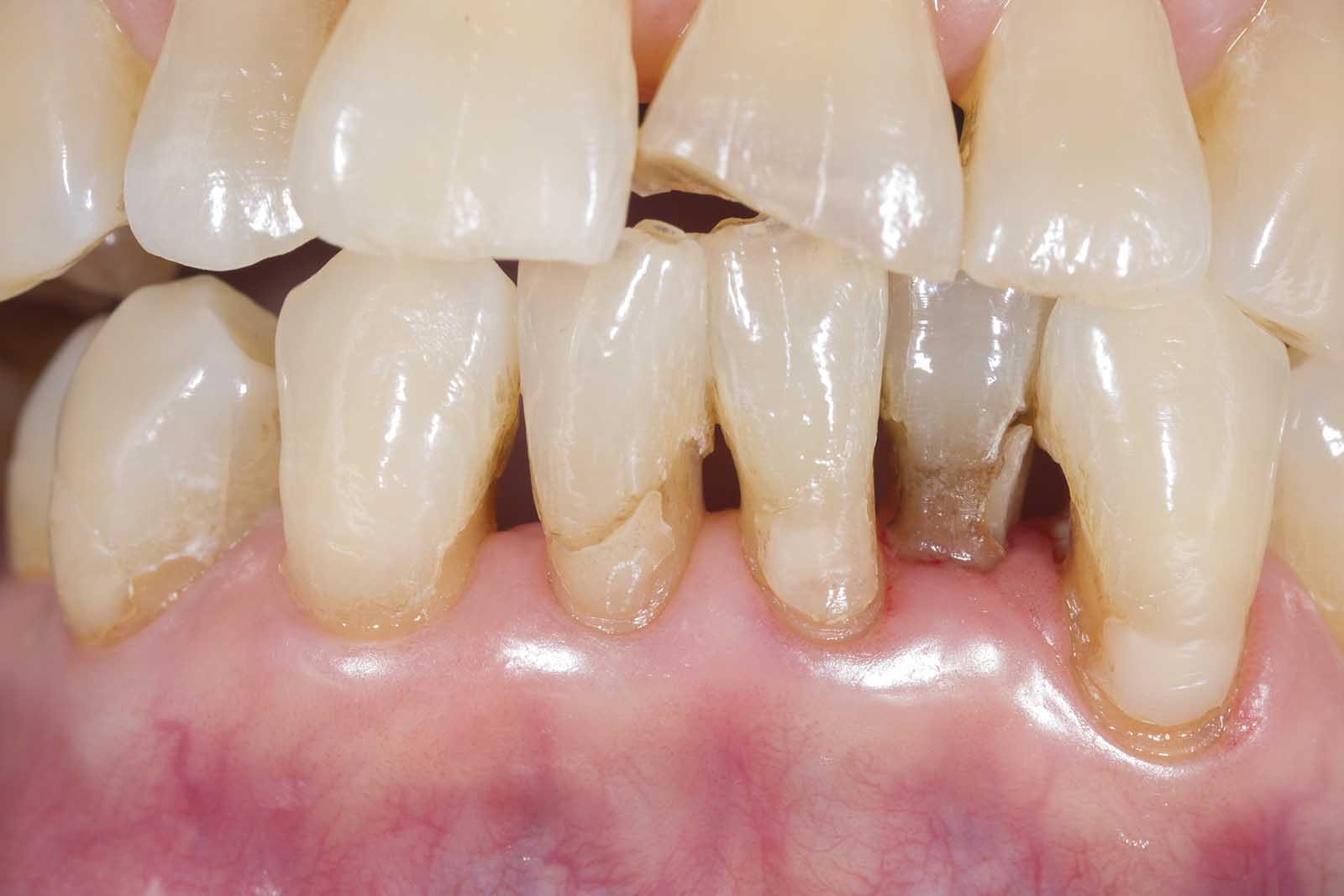 Gum Recession - Receding Gums From Gum Inflammation