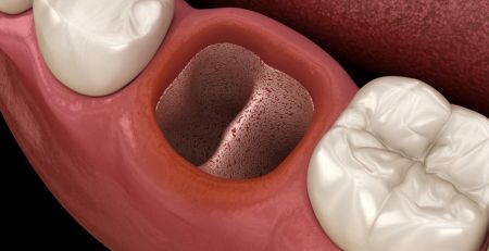 What is Dry Socket in Dentistry?