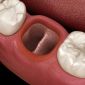 What is Dry Socket in Dentistry?