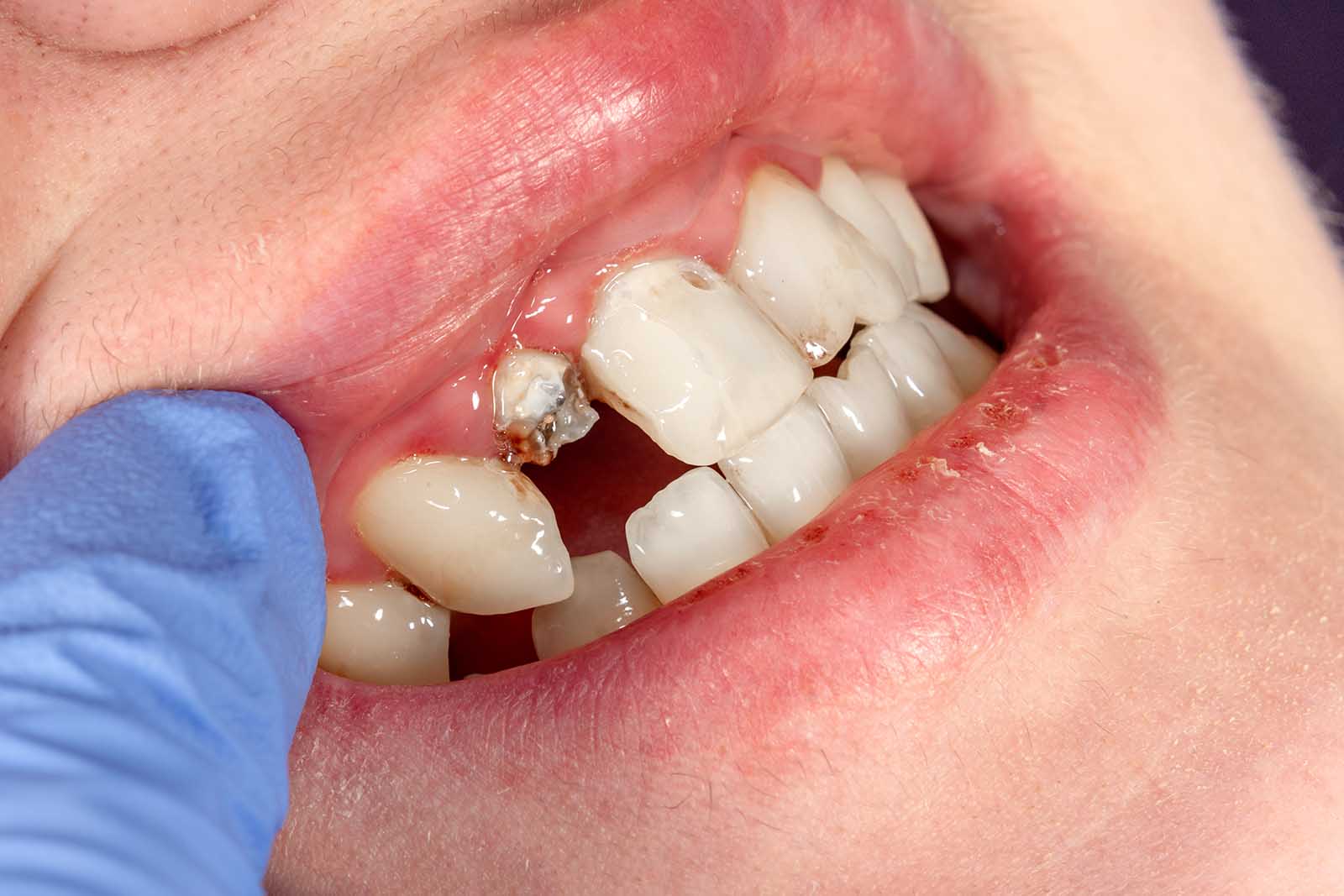 Consequences Of An Untreated Root Canal