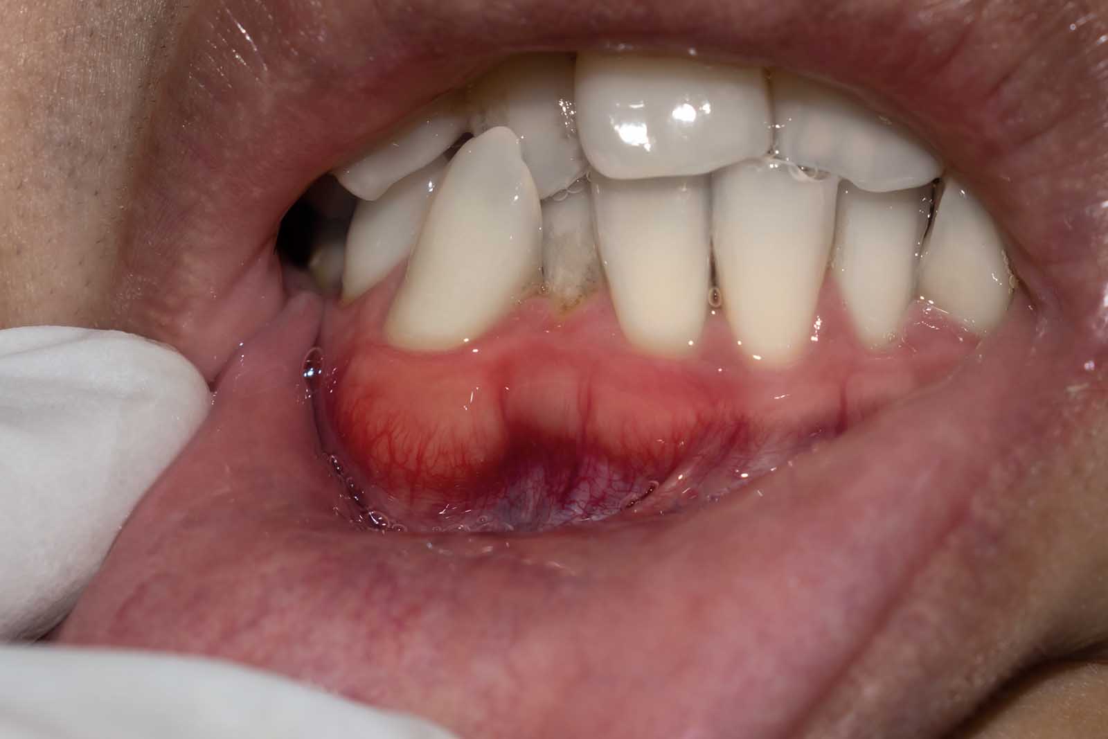 Gum Infection From Untreated Root Canal