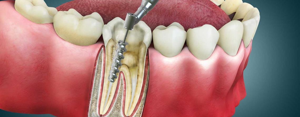 Root canal therapy risks and complications