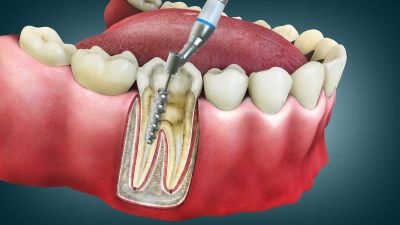 Root Canal Therapy Risks and Complications