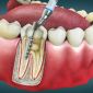 Root Canal Therapy Risks and Complications