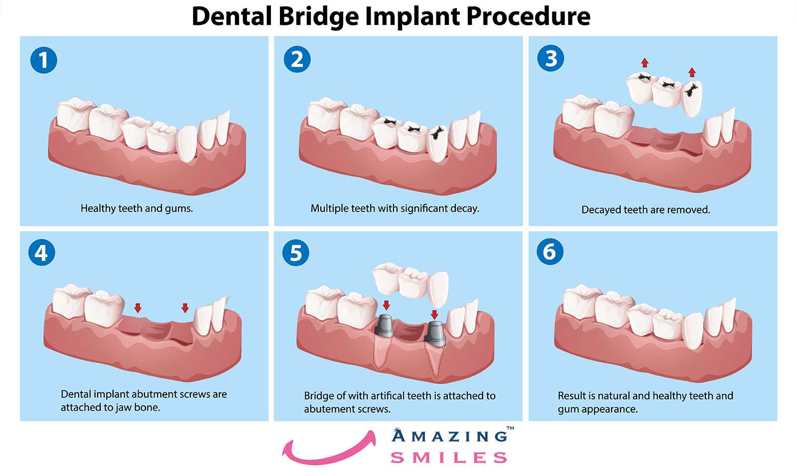 Dental Bridge Implant Procedure